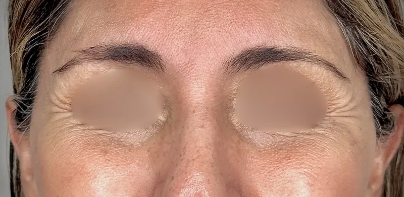 Before treatment