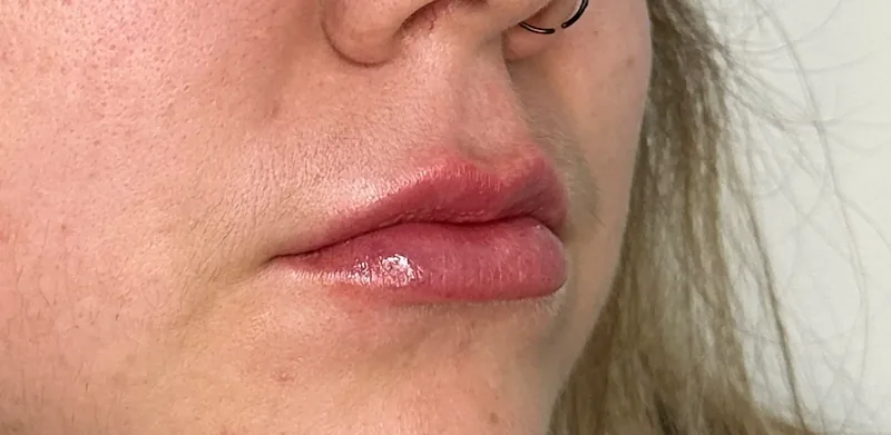 After treatment