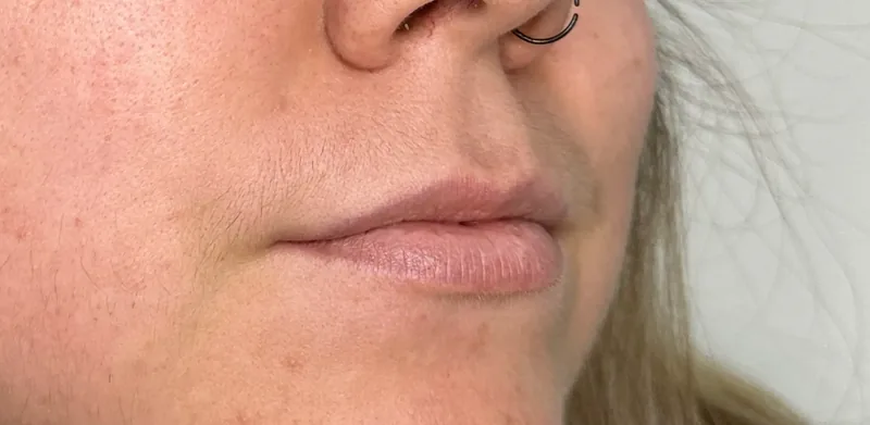 Before treatment