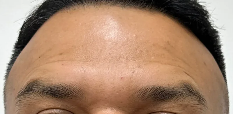 After treatment