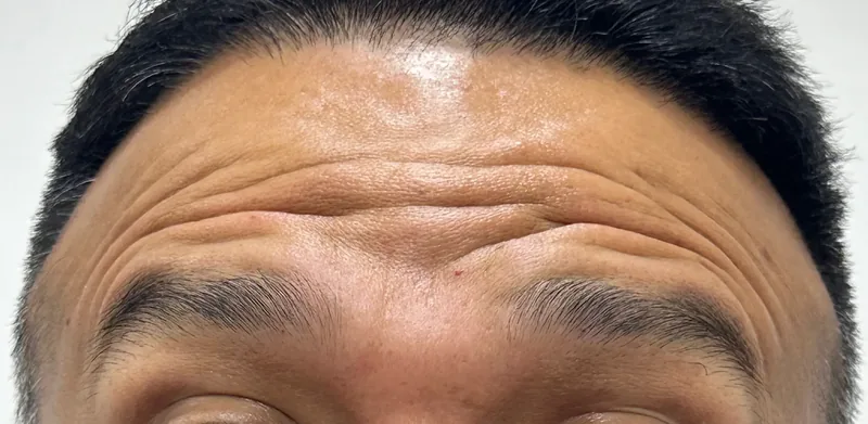 Before treatment
