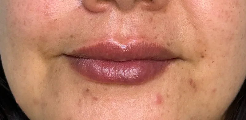 After treatment
