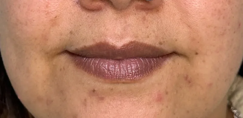 Before treatment