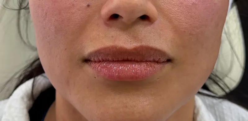 After treatment