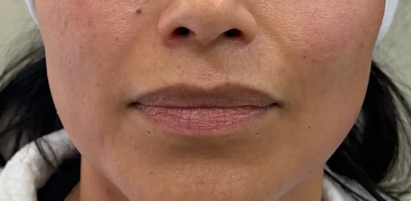 Before treatment