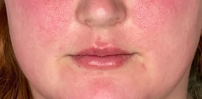 After treatment