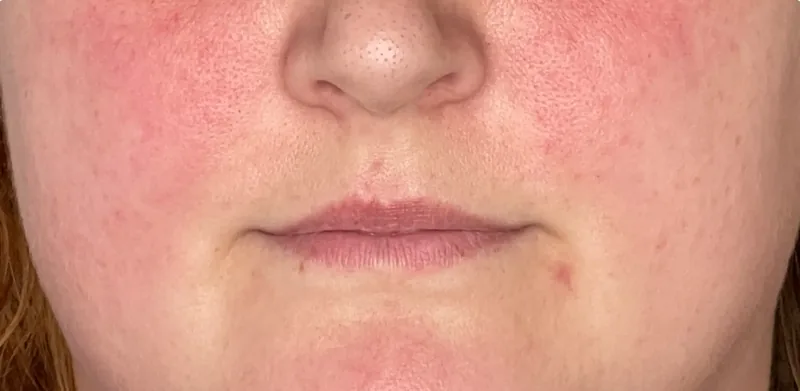 Before treatment