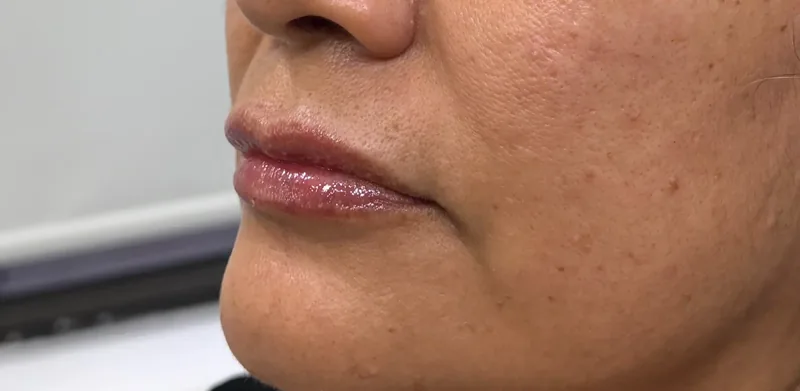 After treatment