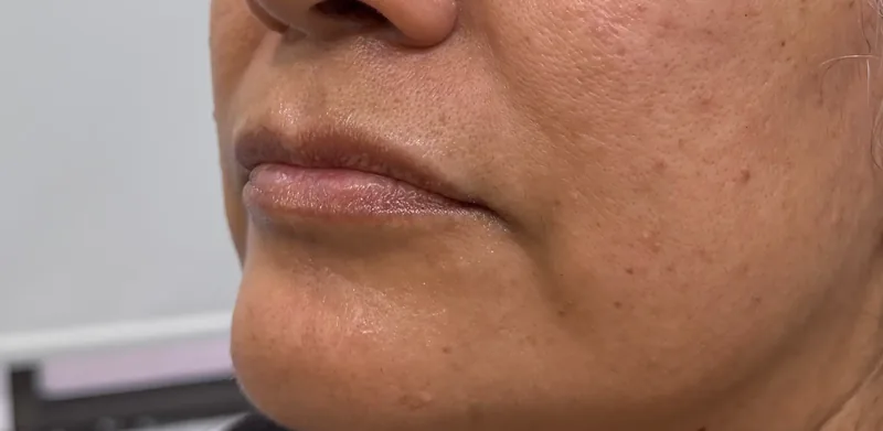 Before treatment