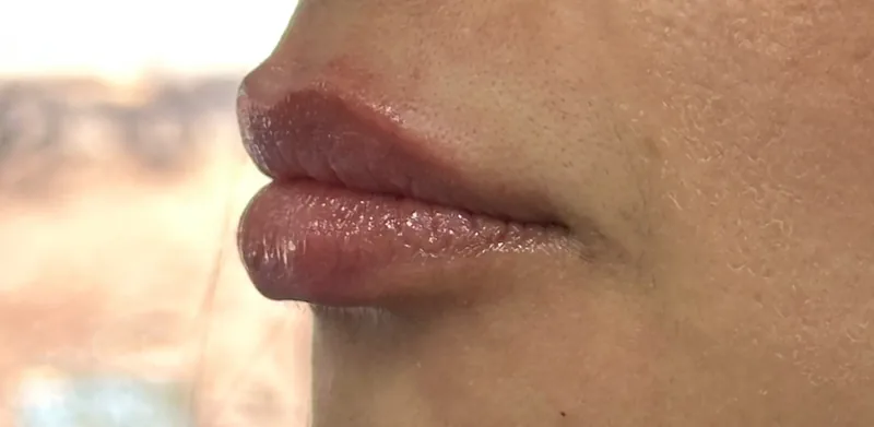 After treatment