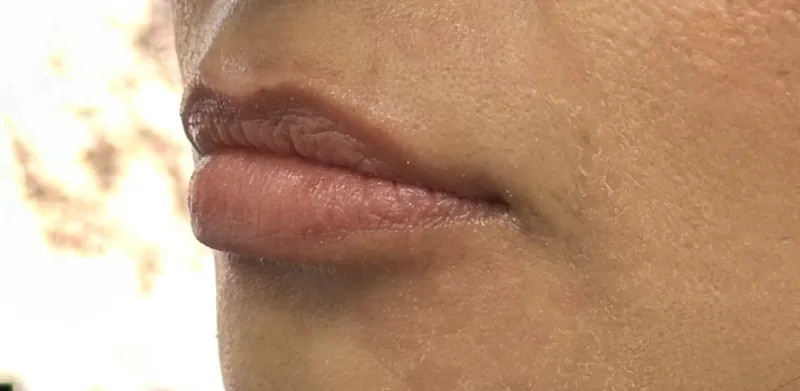 Before treatment