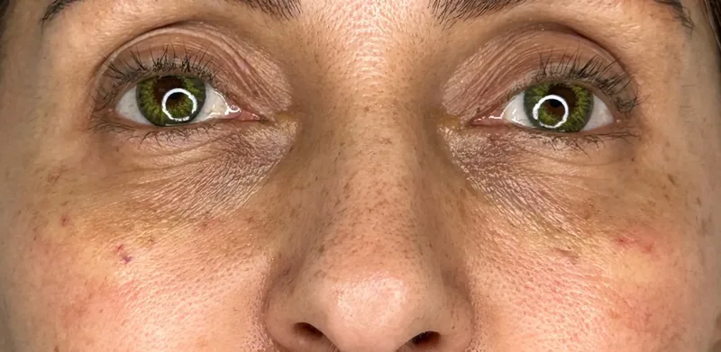 After treatment
