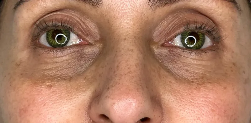 Before treatment