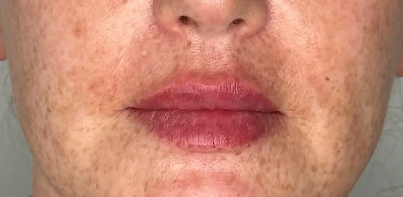 After treatment