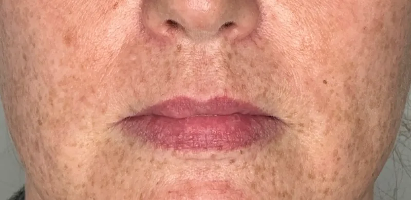 Before treatment