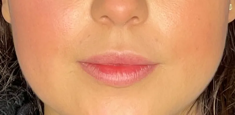 Before treatment