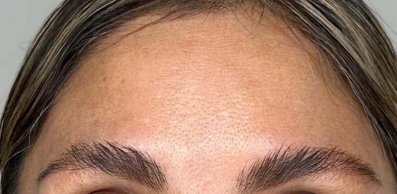 After treatment