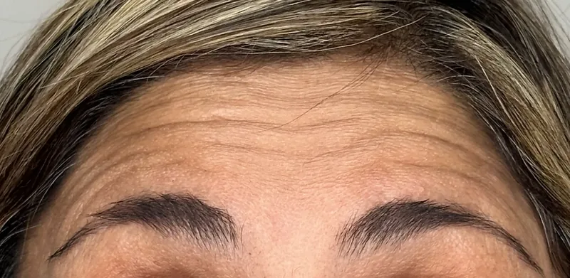 Before treatment